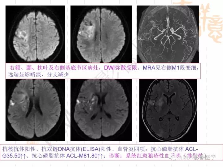 【PPT】中枢神经系统血管炎(CNSV)的表现与特征
