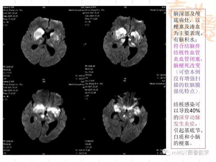 【PPT】中枢神经系统血管炎(CNSV)的表现与特征