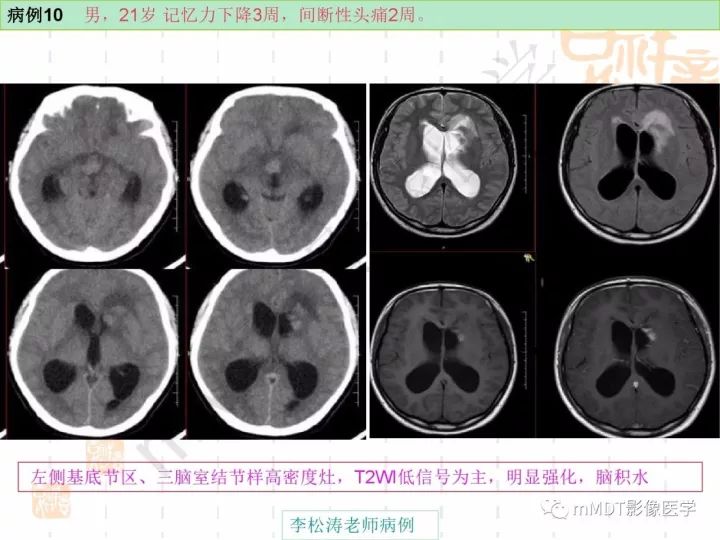 【PPT】中枢神经系统血管炎(CNSV)的表现与特征
