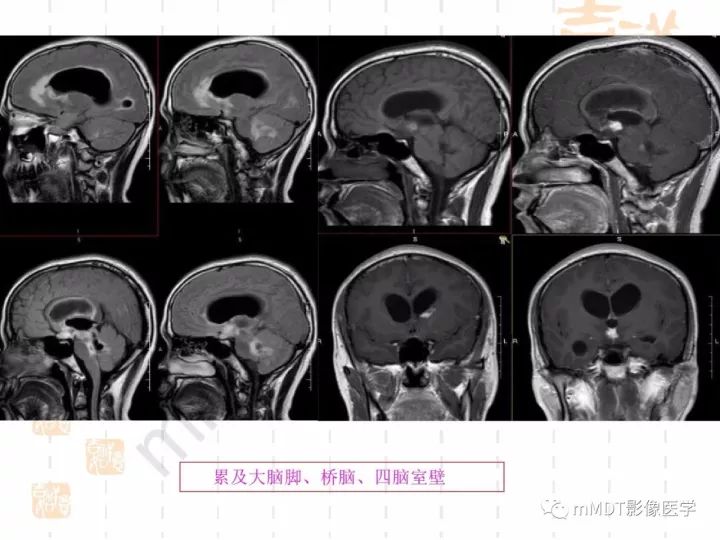 【PPT】中枢神经系统血管炎(CNSV)的表现与特征