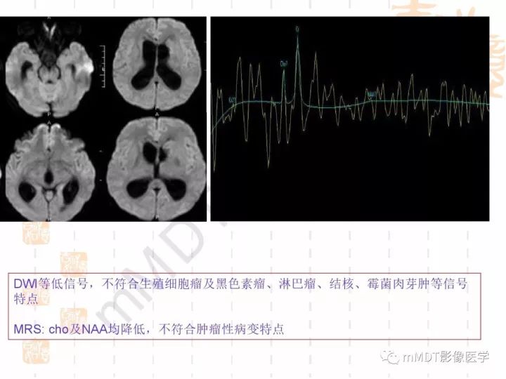 【PPT】中枢神经系统血管炎(CNSV)的表现与特征