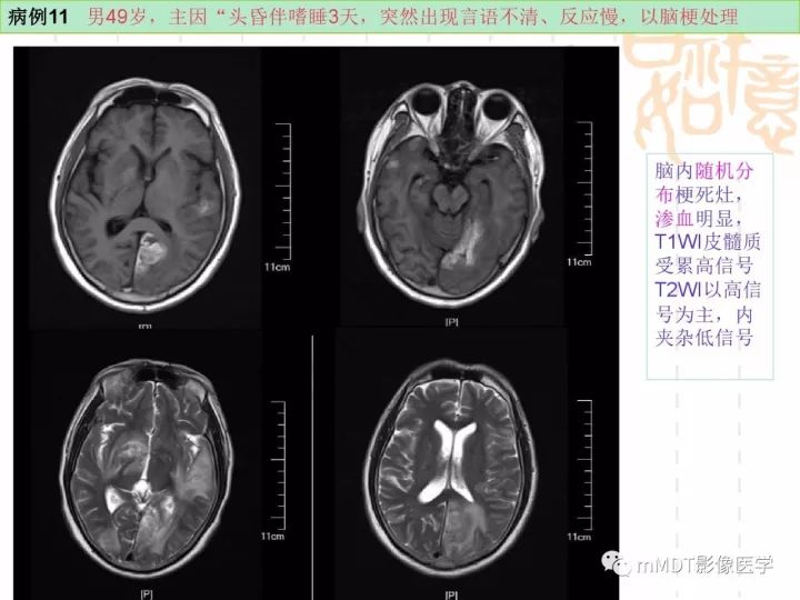 【PPT】中枢神经系统血管炎(CNSV)的表现与特征