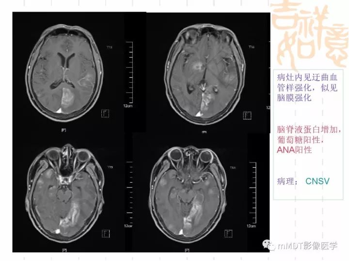 【PPT】中枢神经系统血管炎(CNSV)的表现与特征