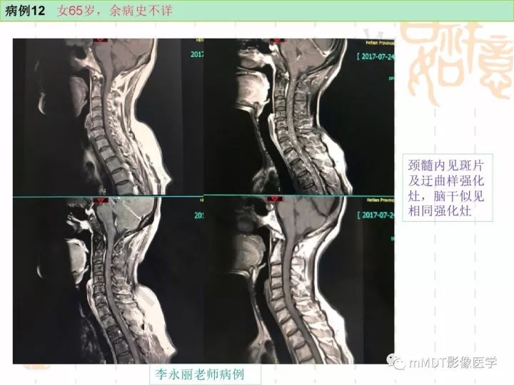 【PPT】中枢神经系统血管炎(CNSV)的表现与特征