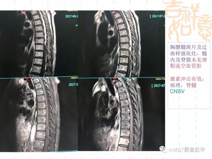 【PPT】中枢神经系统血管炎(CNSV)的表现与特征