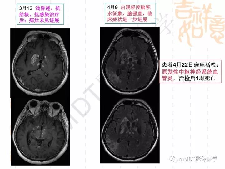 【PPT】中枢神经系统血管炎(CNSV)的表现与特征