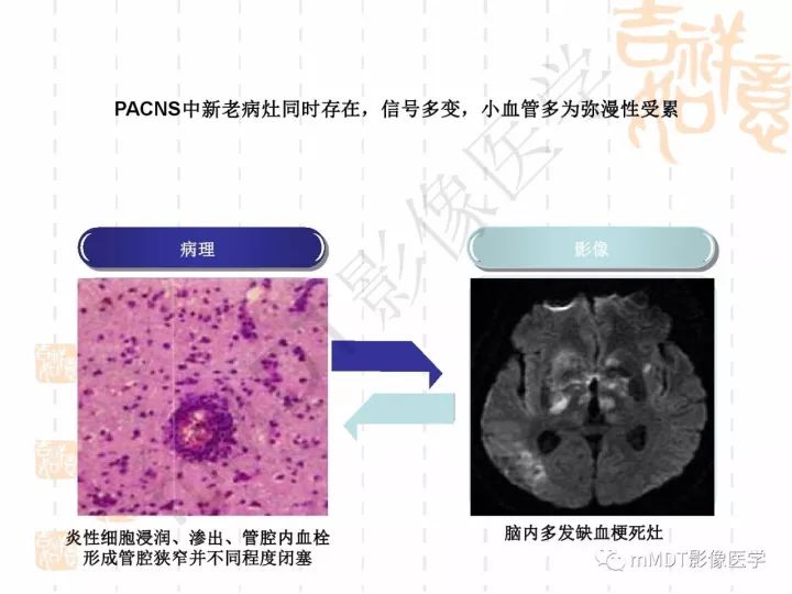 【PPT】中枢神经系统血管炎(CNSV)的表现与特征