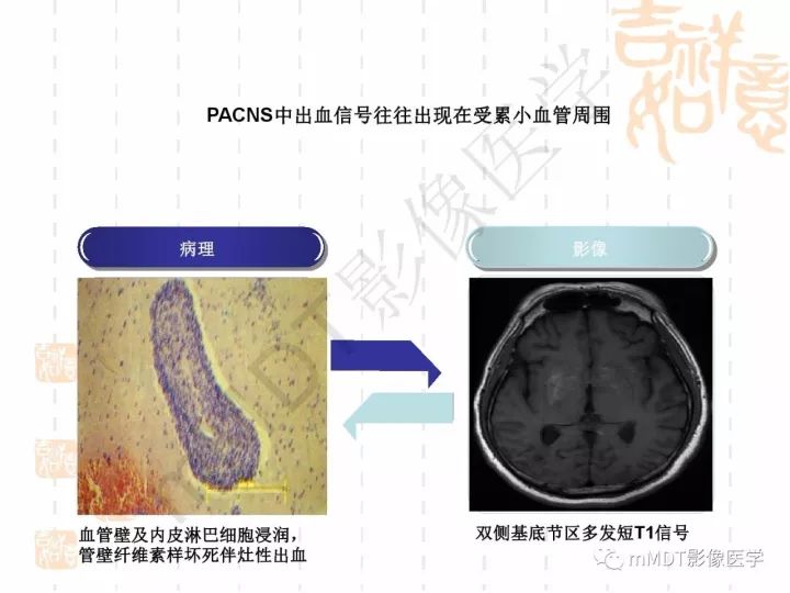 【PPT】中枢神经系统血管炎(CNSV)的表现与特征