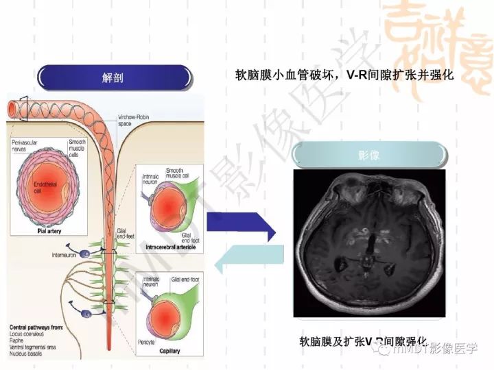 【PPT】中枢神经系统血管炎(CNSV)的表现与特征