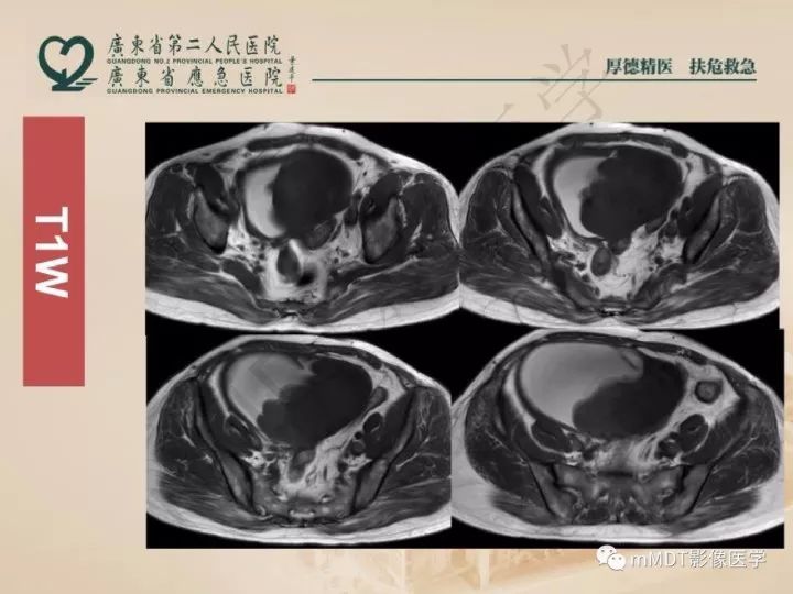 【PPT】卵巢肿瘤读片