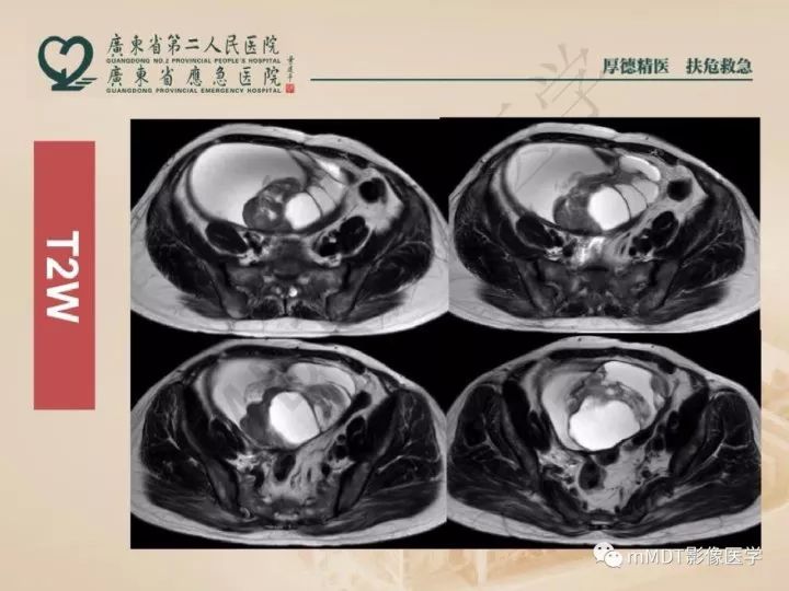 【PPT】卵巢肿瘤读片