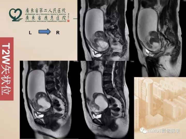 【PPT】卵巢肿瘤读片