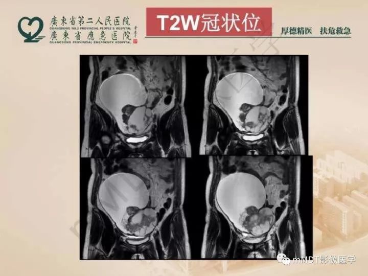 【PPT】卵巢肿瘤读片