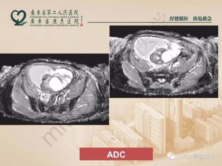【PPT】卵巢肿瘤读片