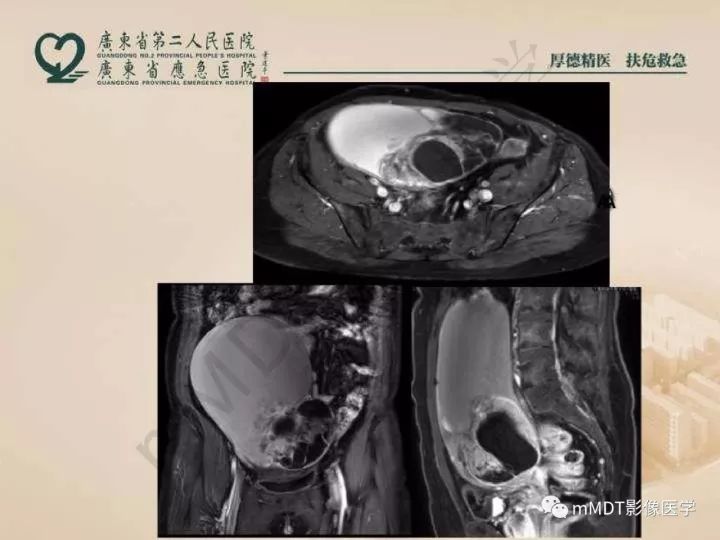 【PPT】卵巢肿瘤读片