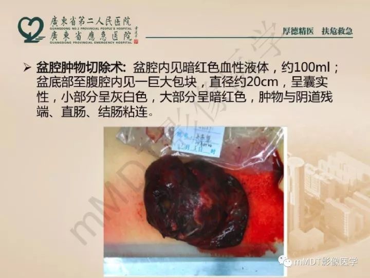 【PPT】卵巢肿瘤读片