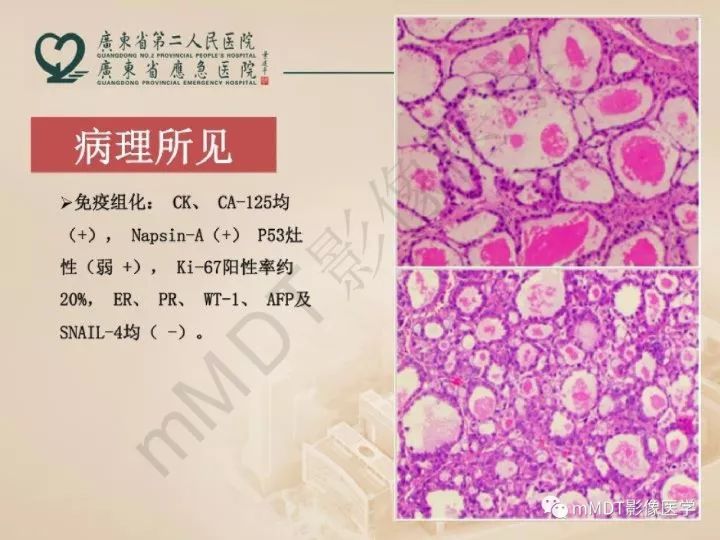 【PPT】卵巢肿瘤读片
