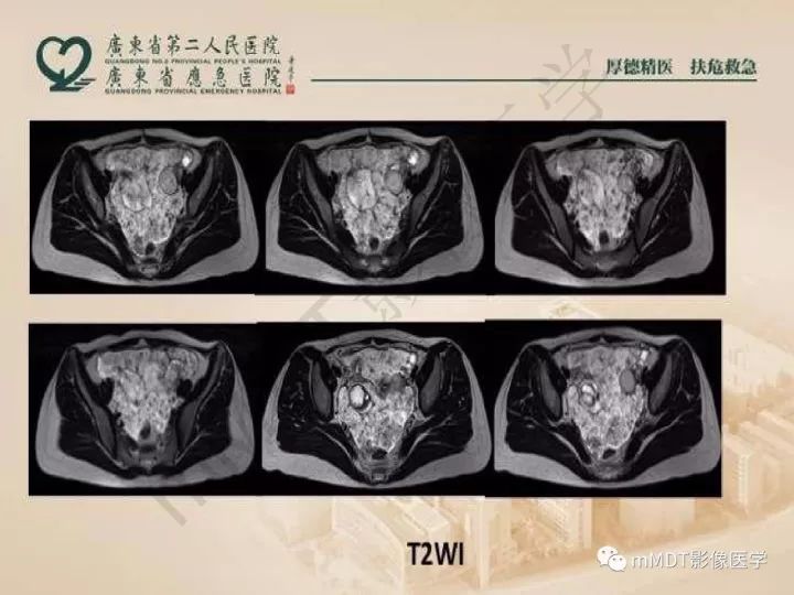 【PPT】卵巢肿瘤读片