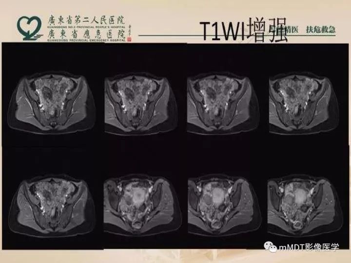 【PPT】卵巢肿瘤读片
