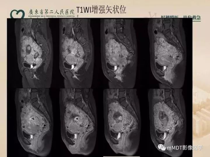 【PPT】卵巢肿瘤读片