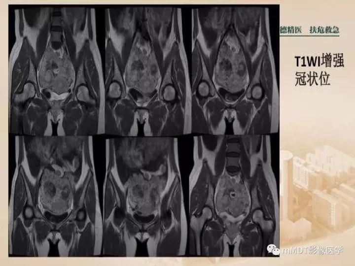 【PPT】卵巢肿瘤读片