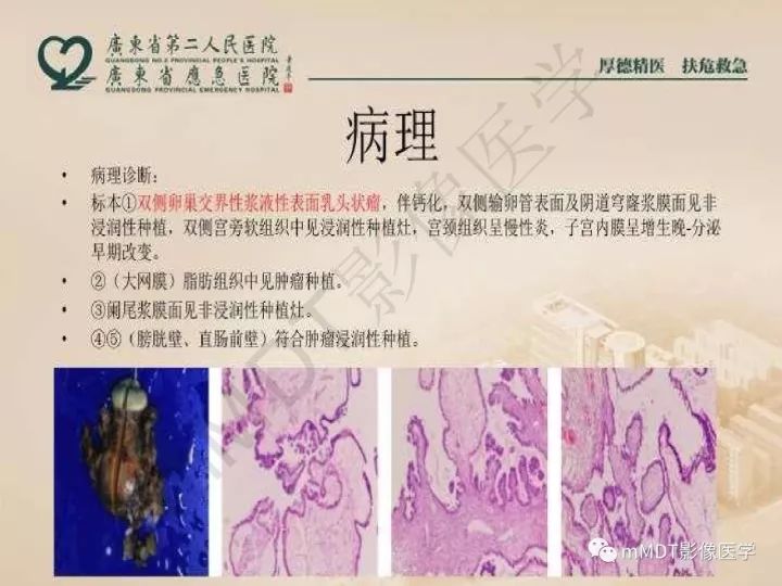 【PPT】卵巢肿瘤读片