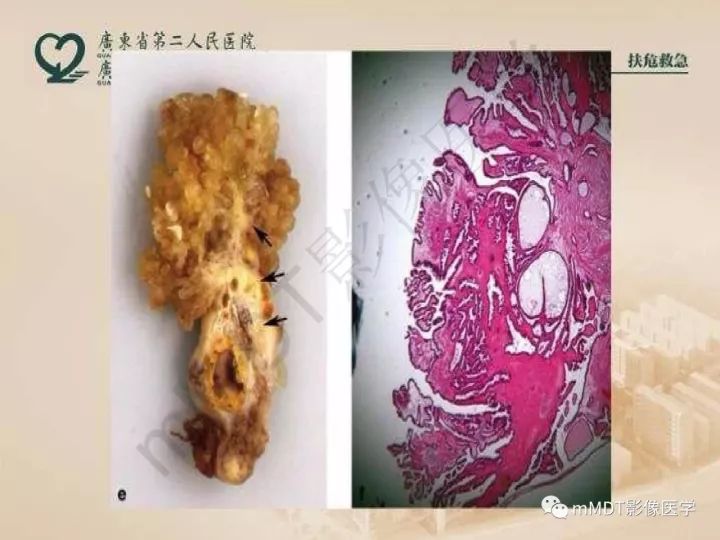 【PPT】卵巢肿瘤读片