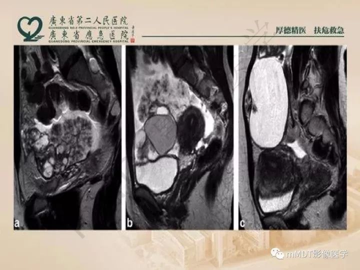 【PPT】卵巢肿瘤读片