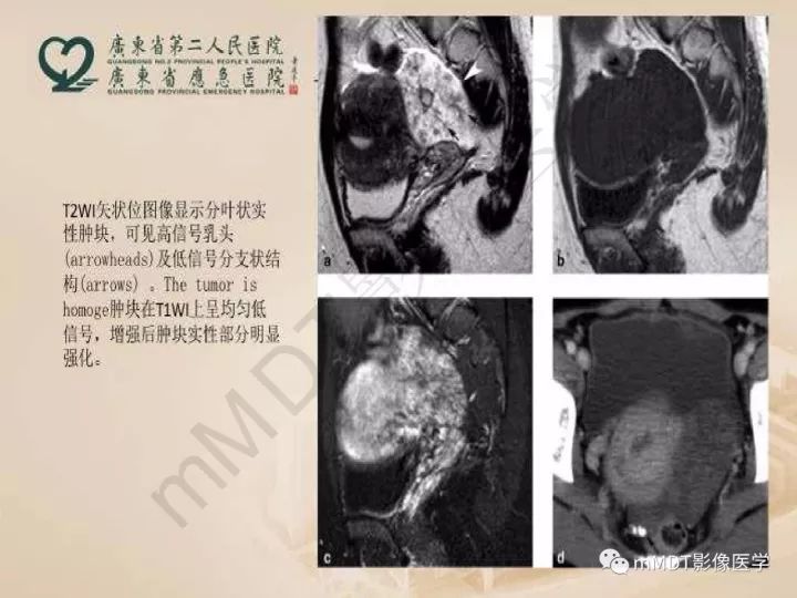 【PPT】卵巢肿瘤读片