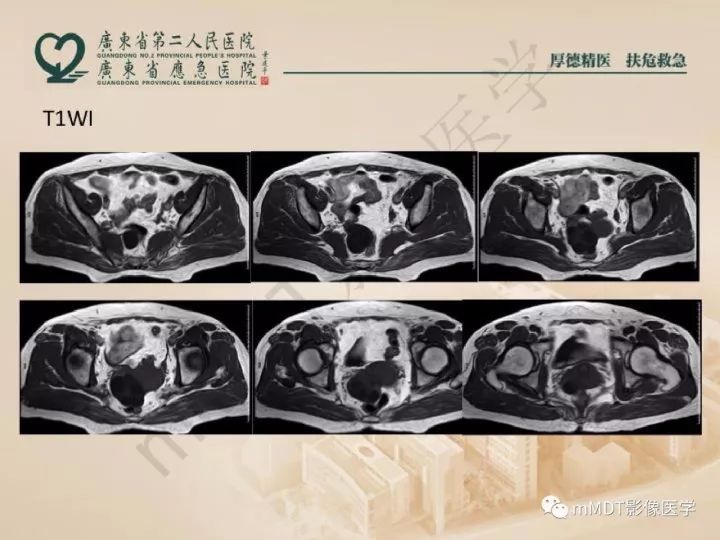 【PPT】卵巢肿瘤读片
