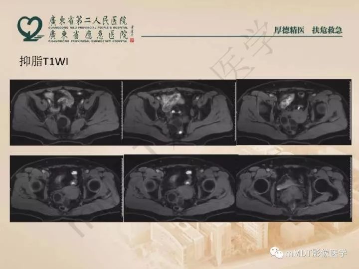 【PPT】卵巢肿瘤读片