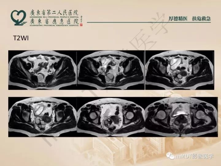 【PPT】卵巢肿瘤读片