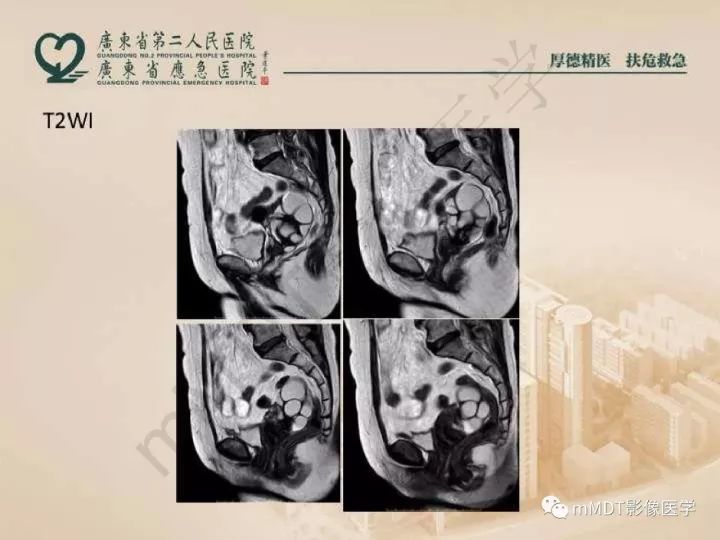 【PPT】卵巢肿瘤读片