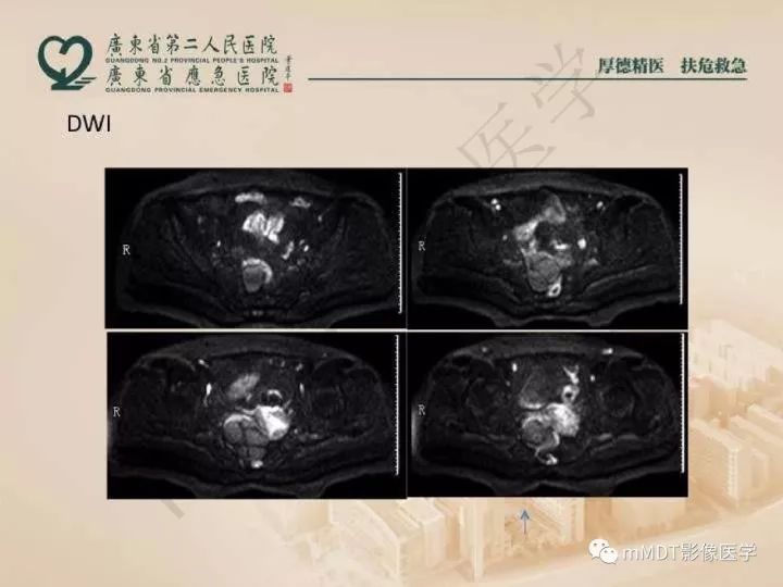 【PPT】卵巢肿瘤读片