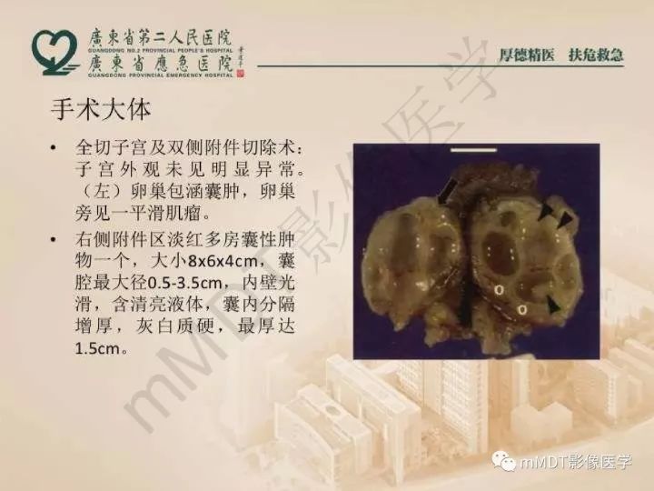 【PPT】卵巢肿瘤读片