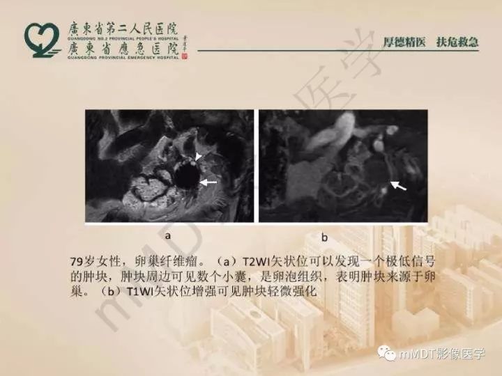 【PPT】卵巢肿瘤读片