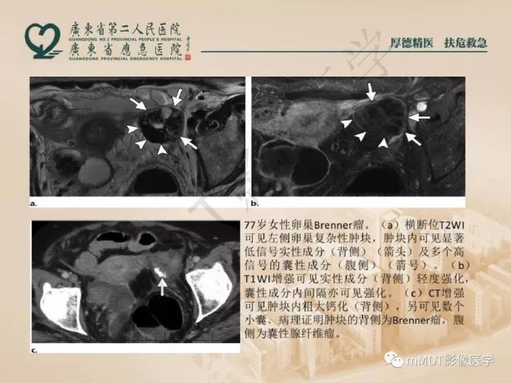 【PPT】卵巢肿瘤读片