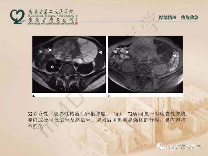 【PPT】卵巢肿瘤读片