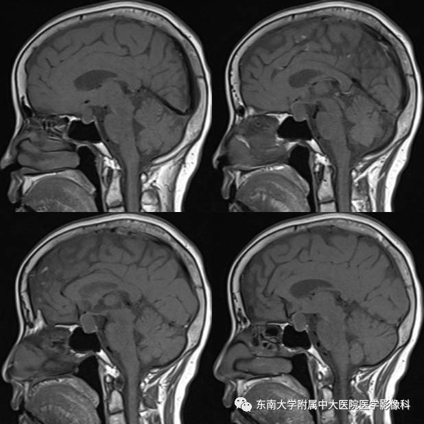 【病例】垂体瘤囊性变1例MR影像诊断