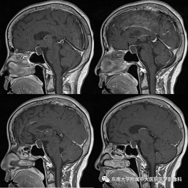 【病例】垂体瘤囊性变1例MR影像诊断