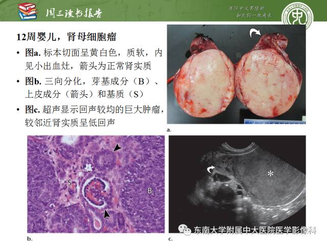【PPT】儿童肾肿瘤：影像-病理相关性第一部分(0 ~ 10岁)