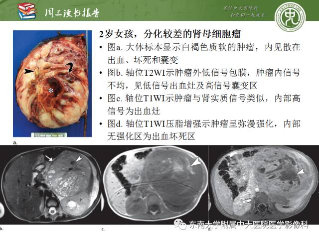【PPT】儿童肾肿瘤：影像-病理相关性第一部分(0 ~ 10岁)