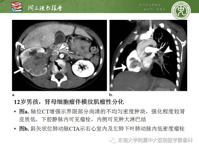 【PPT】儿童肾肿瘤：影像-病理相关性第一部分(0 ~ 10岁)