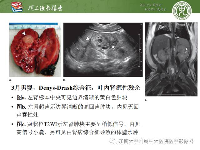 【PPT】儿童肾肿瘤：影像-病理相关性第一部分(0 ~ 10岁)