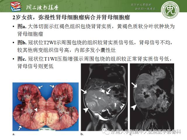 【PPT】儿童肾肿瘤：影像-病理相关性第一部分(0 ~ 10岁)