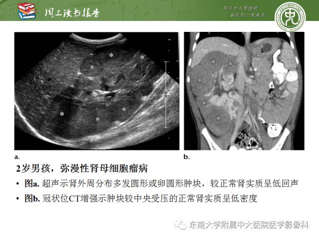 【PPT】儿童肾肿瘤：影像-病理相关性第一部分(0 ~ 10岁)