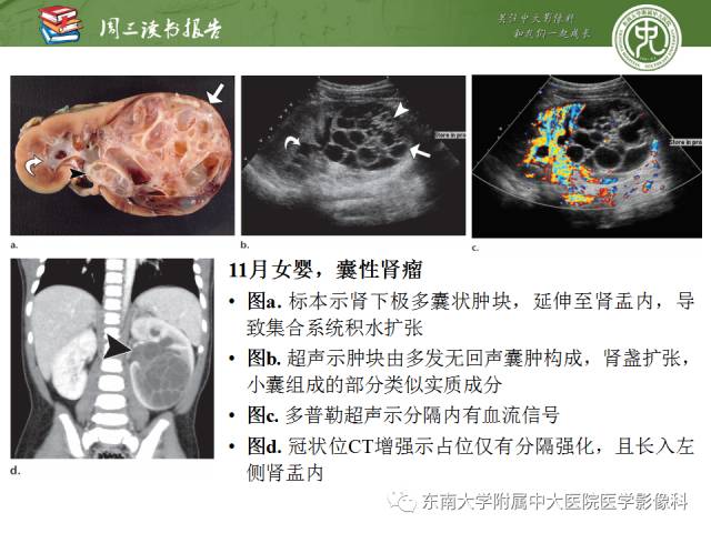 【PPT】儿童肾肿瘤：影像-病理相关性第一部分(0 ~ 10岁)