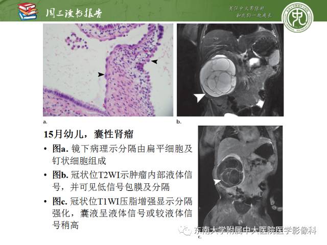 【PPT】儿童肾肿瘤：影像-病理相关性第一部分(0 ~ 10岁)