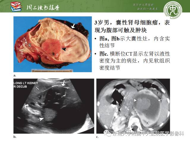 【PPT】儿童肾肿瘤：影像-病理相关性第一部分(0 ~ 10岁)