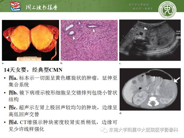 【PPT】儿童肾肿瘤：影像-病理相关性第一部分(0 ~ 10岁)